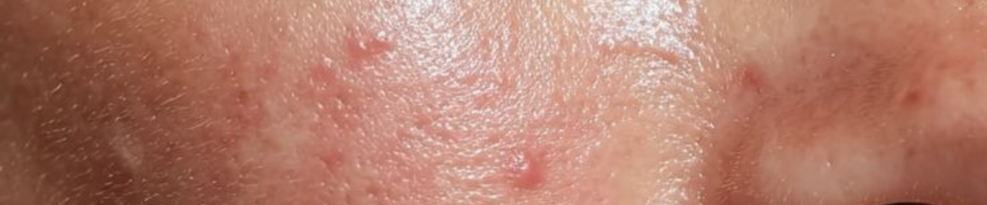 Acne Awareness Month: Why Your Acne Routine Might Be Making Things Worse