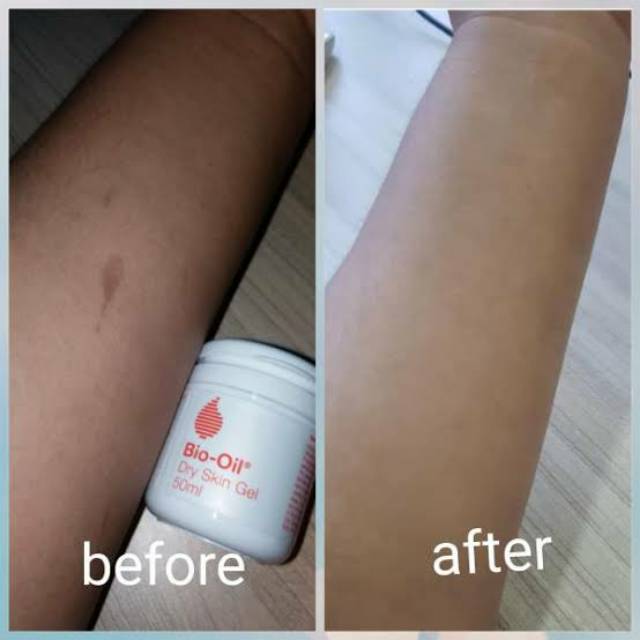 Bio-Oil Dry Skin Gel