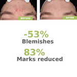 Before and after comparison of acne on a person's face with statistical reduction percentages.