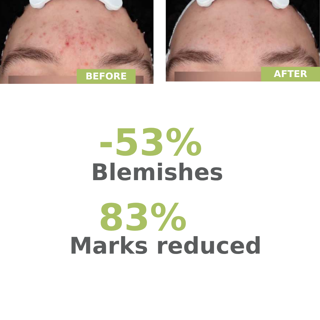 Before and after comparison of acne on a person's face with statistical reduction percentages.