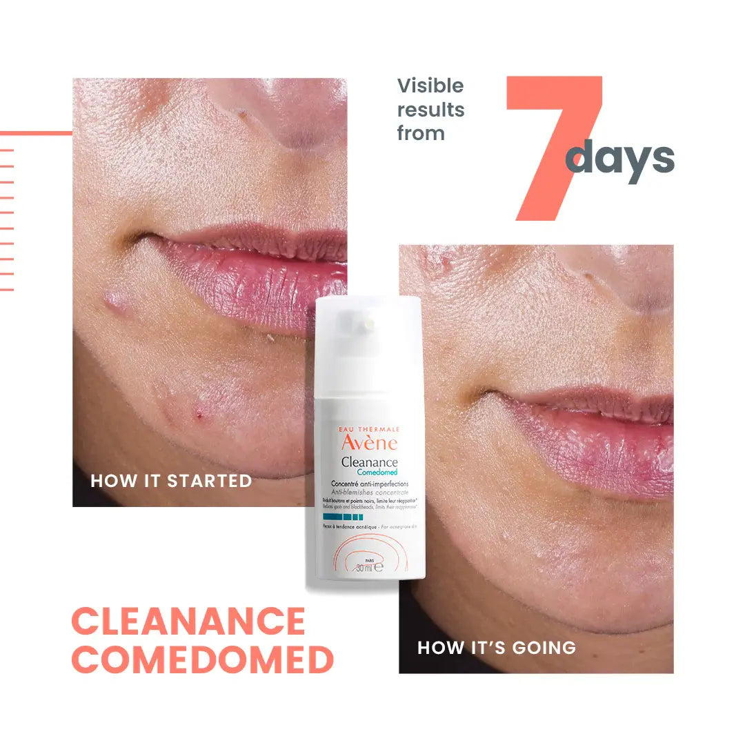 Avène Cleanance Comedomed serum targeting blackheads and blemishes for oily skin