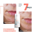 Avène Cleanance Comedomed serum targeting blackheads and blemishes for oily skin