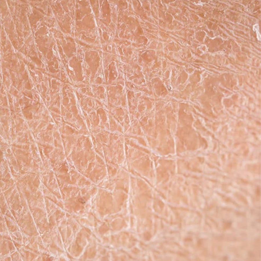 Dry Skin
