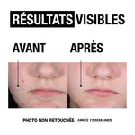 Neutrogena Anti-Blemish+ exfoliant with glycolic acid available at The DistrIQt Lebanon