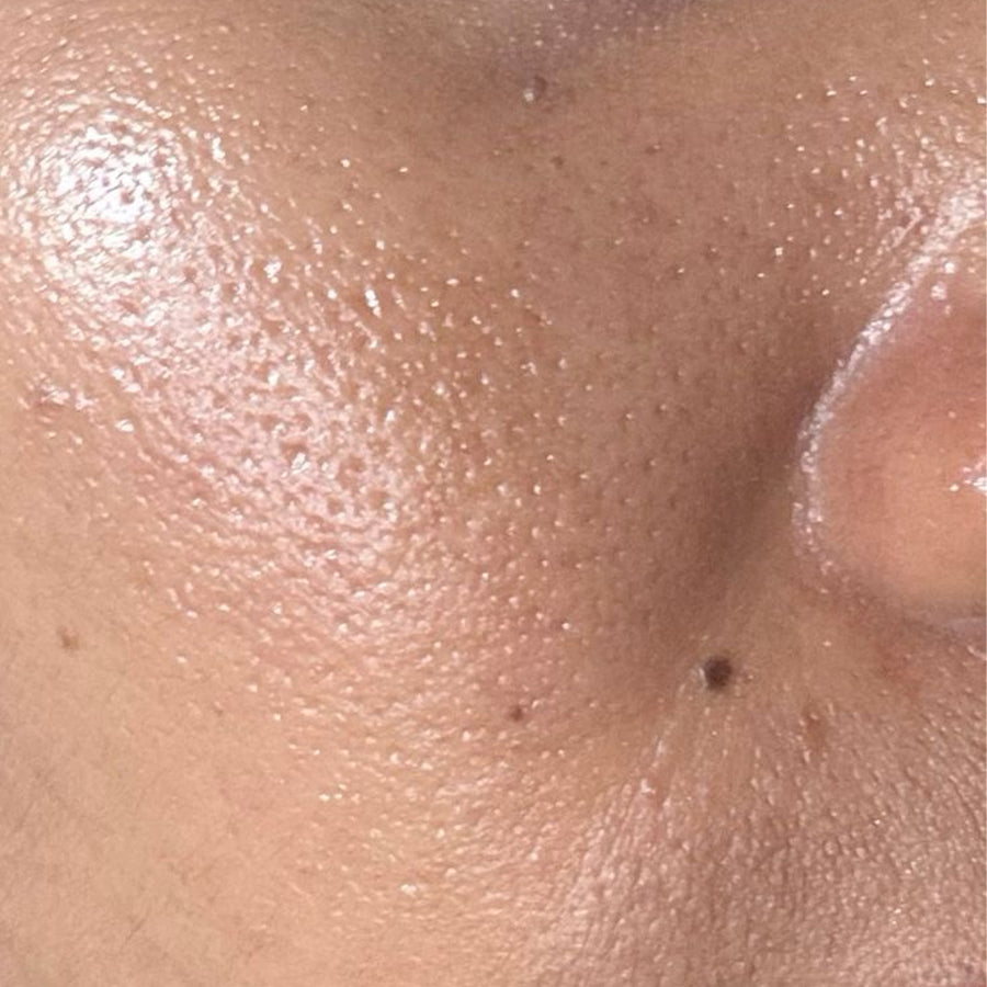 Oily Skin