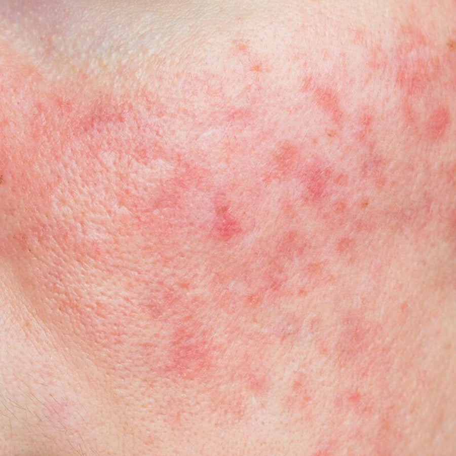 Sensitive Skin